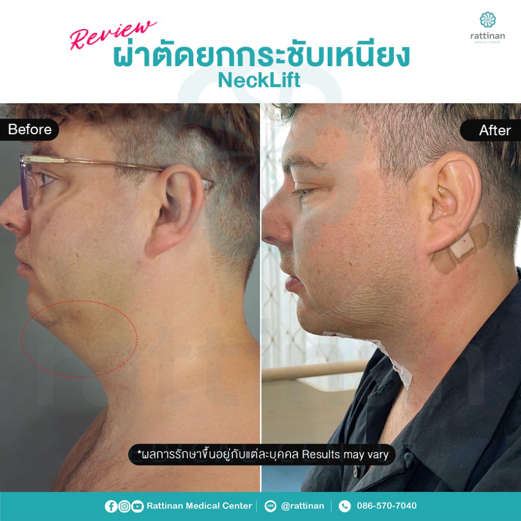 NeckLift ผ่าตัดยกกระชับเหนียง