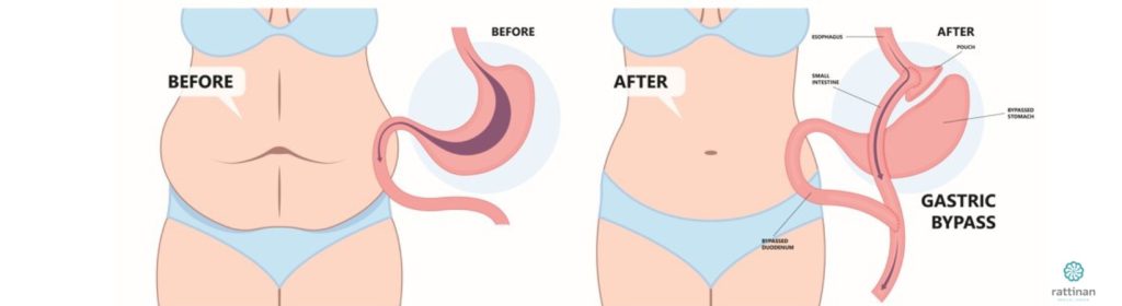 วิธีการผ่าตัดกระเพาะแบบบายพาส (ฺBypass - bariatric surgery)