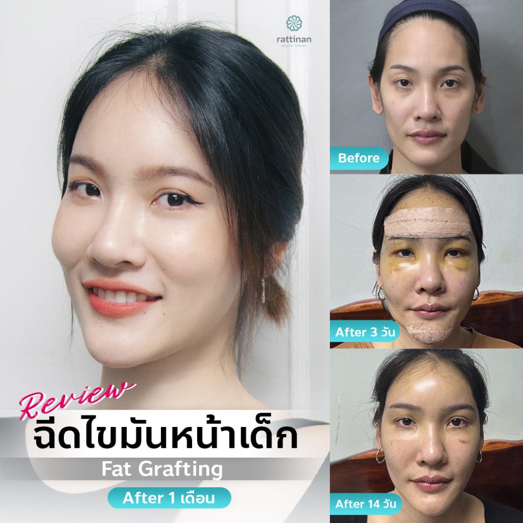 fat grafting รีวิว เติมไขมันหน้า