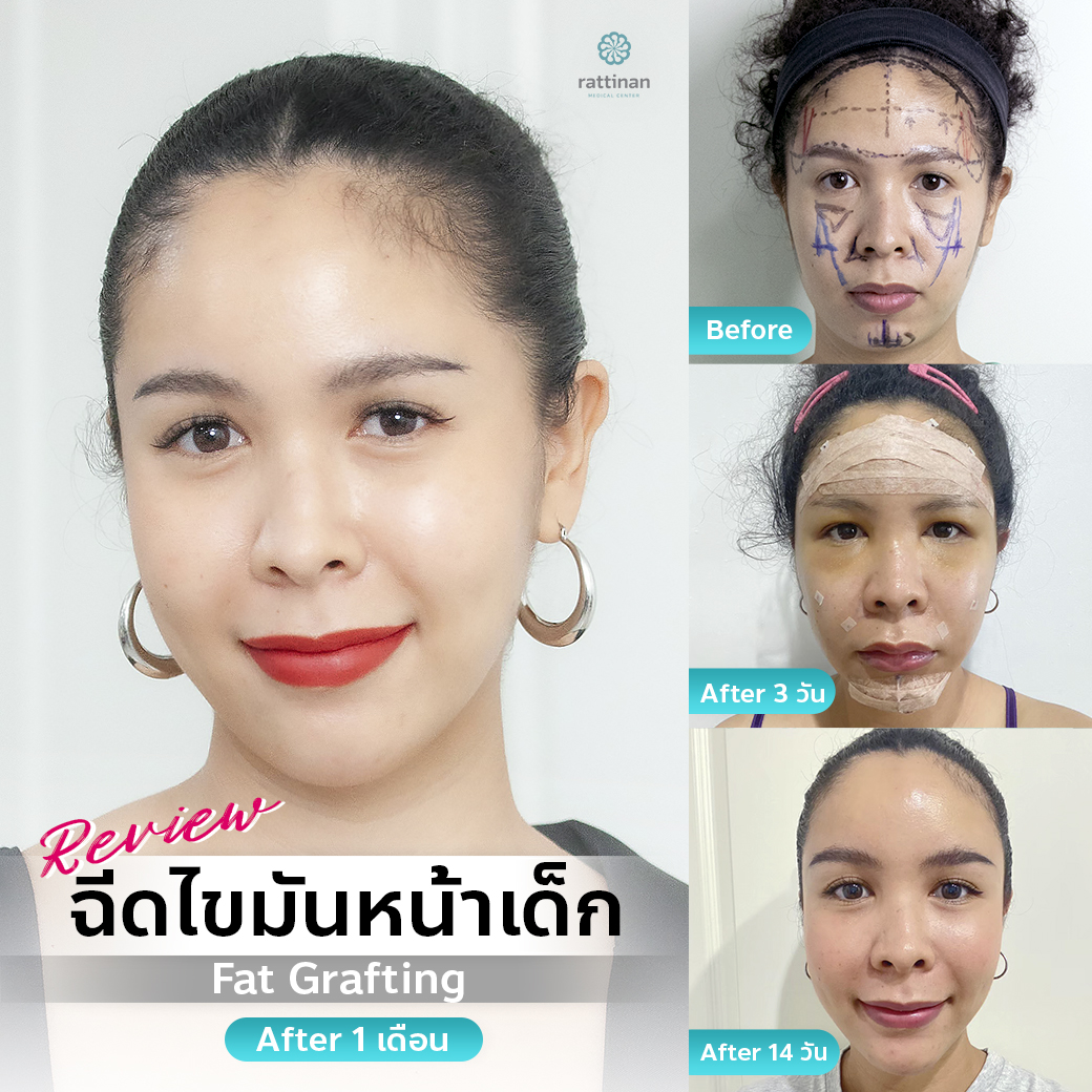 fat grafting รีวิว เติมไขมันหน้า