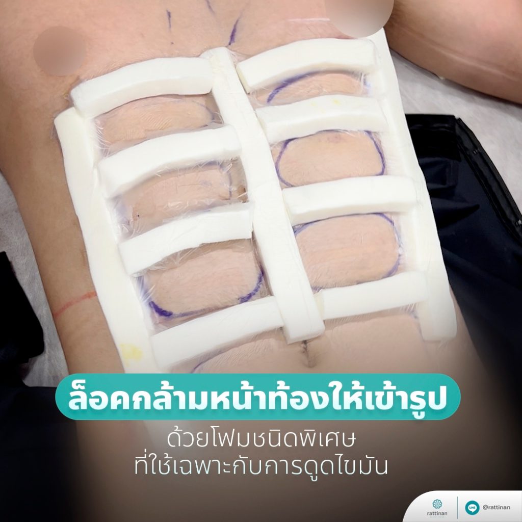 หลังดูดไขมันซอกแพค ล็อคกล้ามหน้าท้องให้เข้ารูป