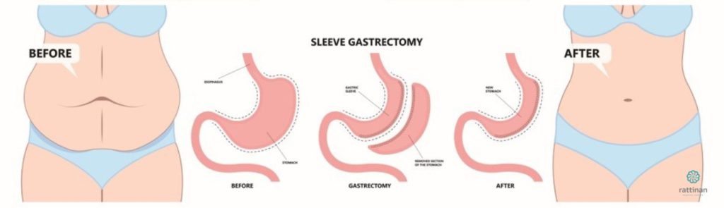วิธีการผ่าตัดกระเพาะแบบสลีฟ (Gastric Sleeve)