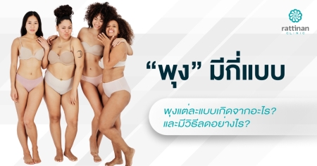 พุง มีกี่แบบ