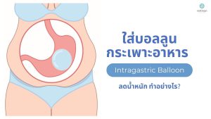 ใส่บอลลูนในกระเพาะอาหาร (Intragastric Balloon) ลดน้ำหนัก ทำอย่างไร?