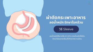 ผ่าตัดกระเพาะแบบสลีฟ (Sleeve Gastric Surgery)