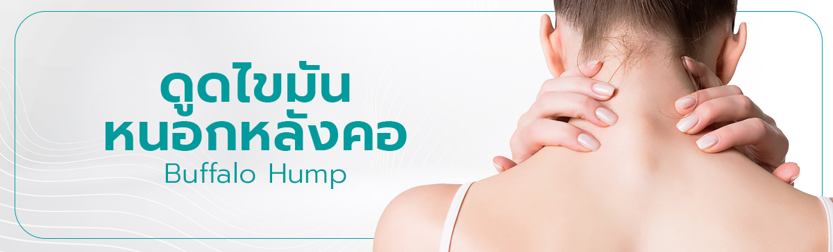 ดูดไขมันหนอกคอ หลังคอ (Buffalo Hump Liposuction)