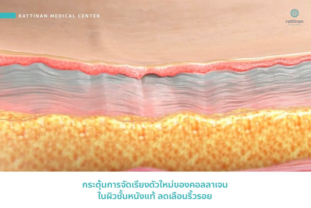 Morpheus 8 ผิวเรียบเนียน