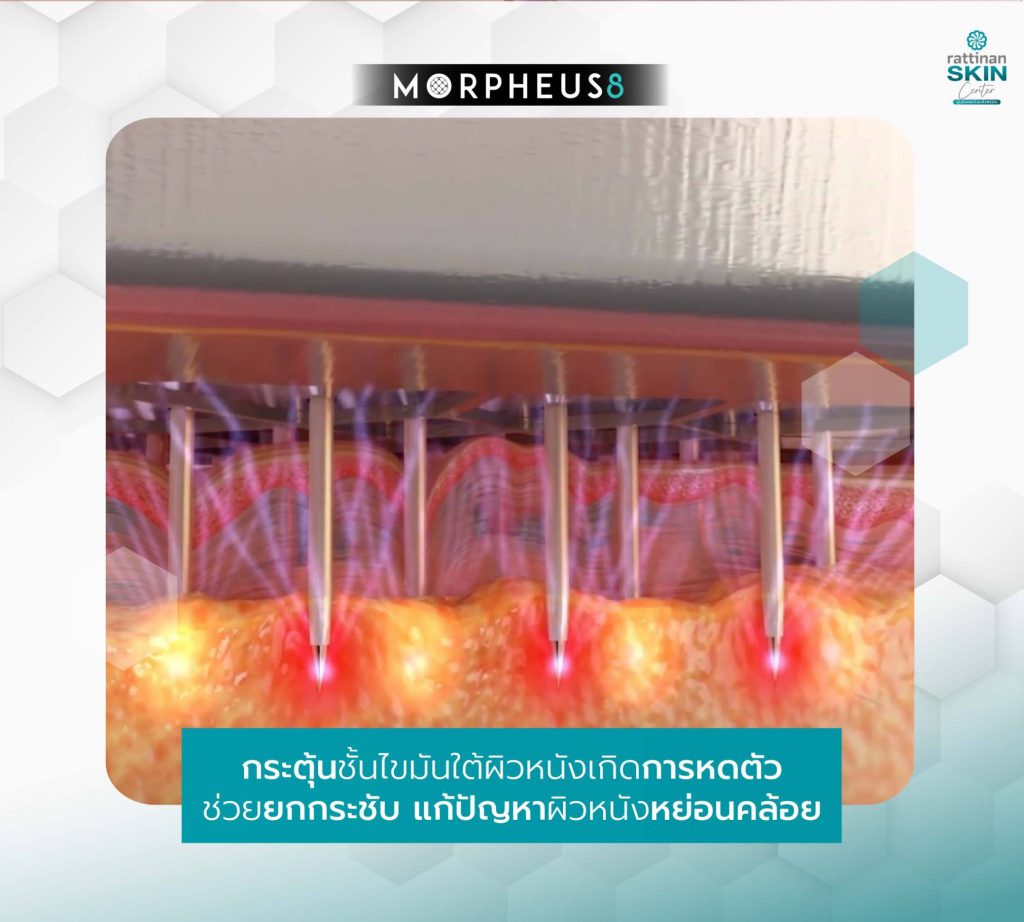 Morpheus 8 ชั้นผิว