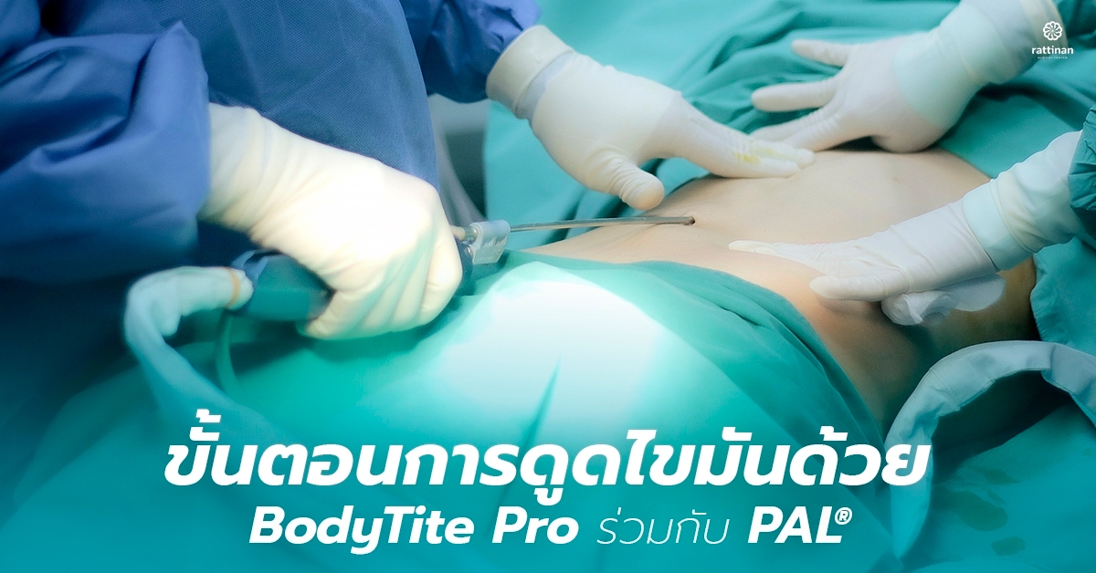 ขั้นตอนดูดไขมัน ด้วย BodyTite กับ PAL