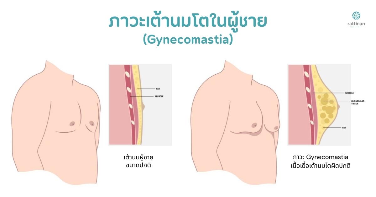 ภาวะเต้านมโตในผู้ชาย หรือ gynecomastia เป็นอย่างไร?