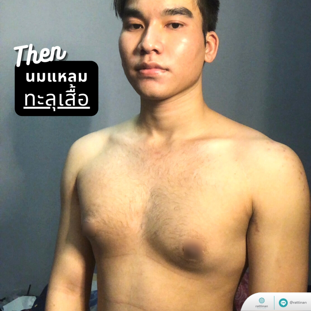 รีวิวจากลูกค้าจริง รักษาภาวะเต้านมโต