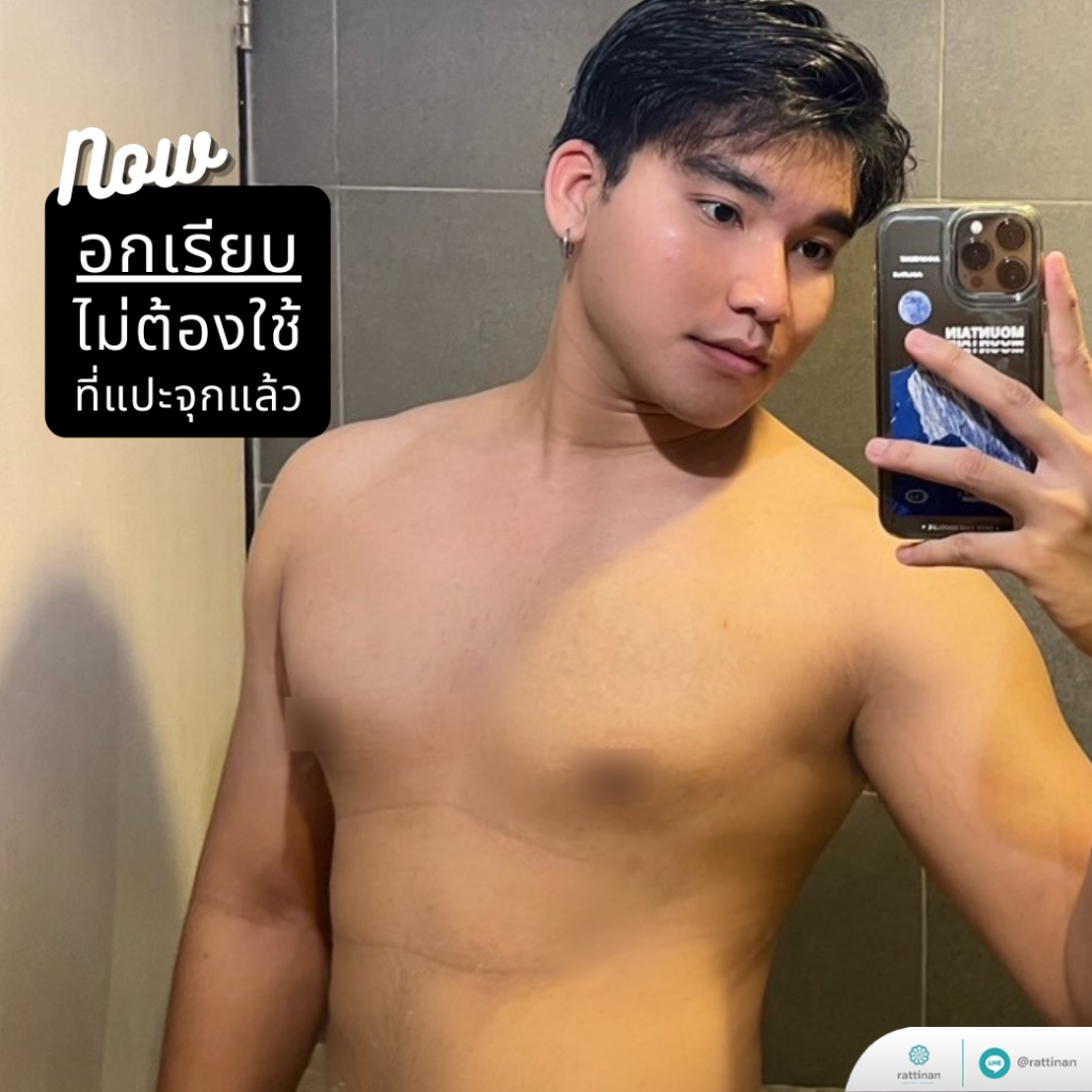 หลังรักษาภาวะเต้านมโต ที่รัตตินันท์ เมดิคอล เซ็นเตอร์