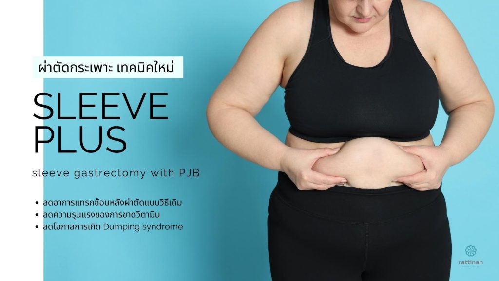 วิธีผ่าตัดกระเพาะ แบบ Sleeve Plus