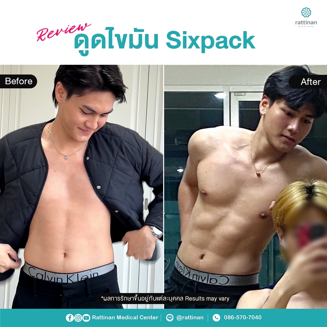 เคสรีวิว ดูดไขมันซิกแพค sixpack liposuction