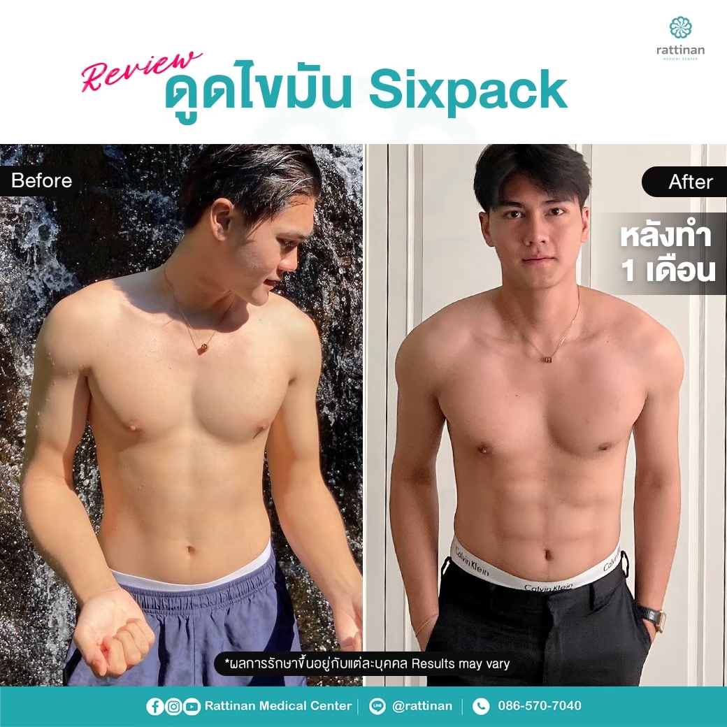 เคสรีวิว ดูดไขมันเคสรีวิว ดูดไขมันซิกแพค six packซิกแพค six pack