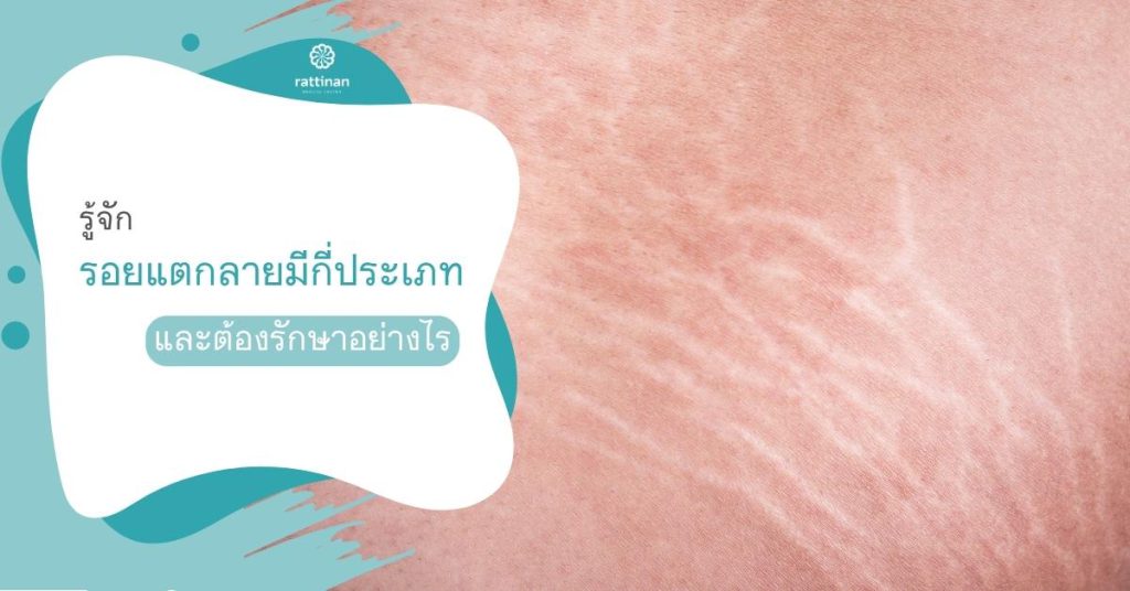 รอยแตกลายมีกี่ประเภท ต้องรักษาอย่างไรให้ผิวเนียน - รัตตินันท์คลินิก รอยแตกลายมีกี่ประเภท ต้องรักษาอย่างไรให้ผิวเนียน - รัตตินันท์คลินิก