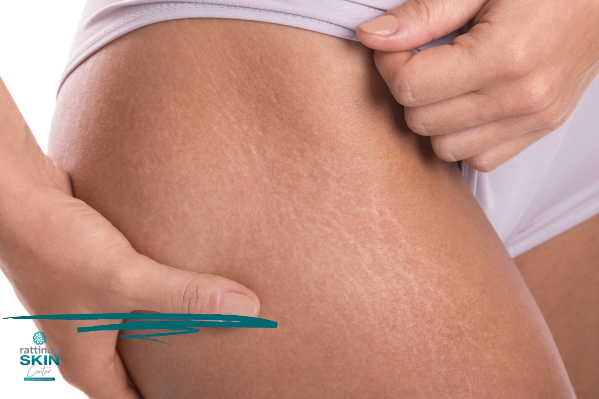 Stria Rash รอยแตกลายมีกี่ประเภท ต้องรักษาอย่างไรให้ผิวเนียน