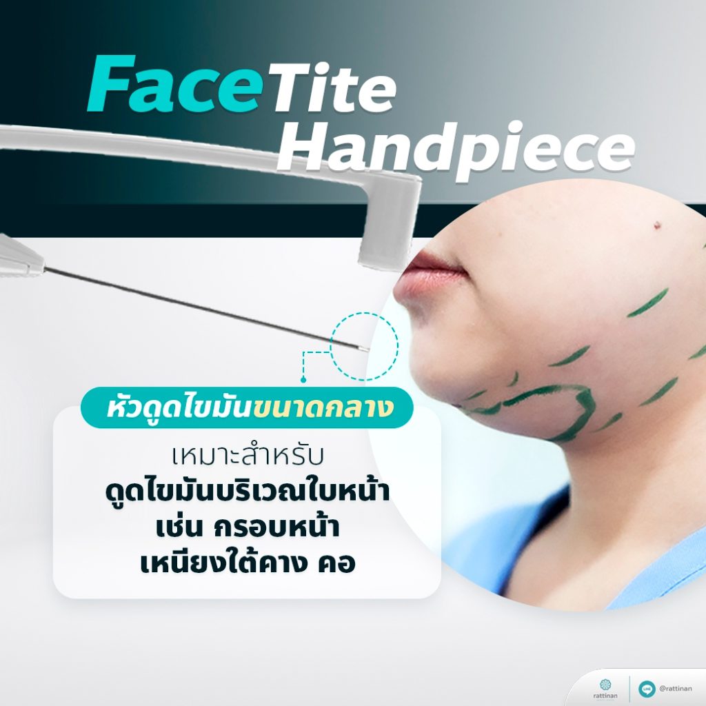 หัวดูดไขมัน facetite handpiece ของเครื่อง BodyTite