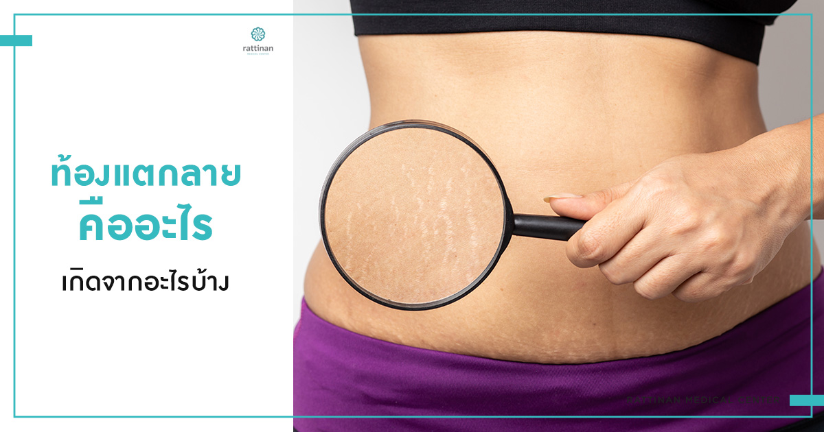 ท้องแตกลาย คืออะไร อาการและสาเหตุเกิดจากอะไรบ้าง พร้อมวิธีรักษา ท้องแตกลาย คืออะไร อาการและสาเหตุเกิดจากอะไรบ้าง พร้อมวิธีรักษา
