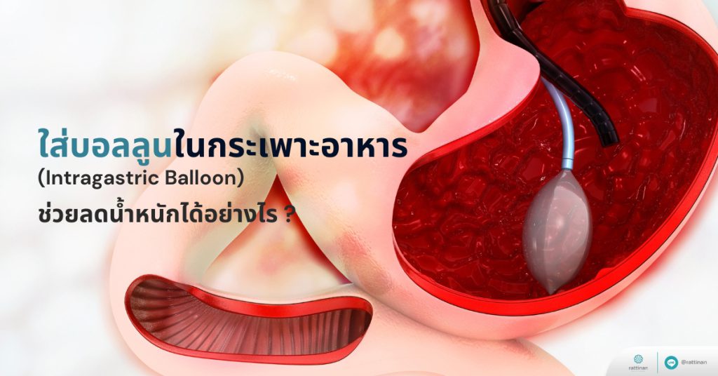 ใส่บอลลูนกระเพาะอาหาร มีข้อดี-ข้อเสียอย่างไร