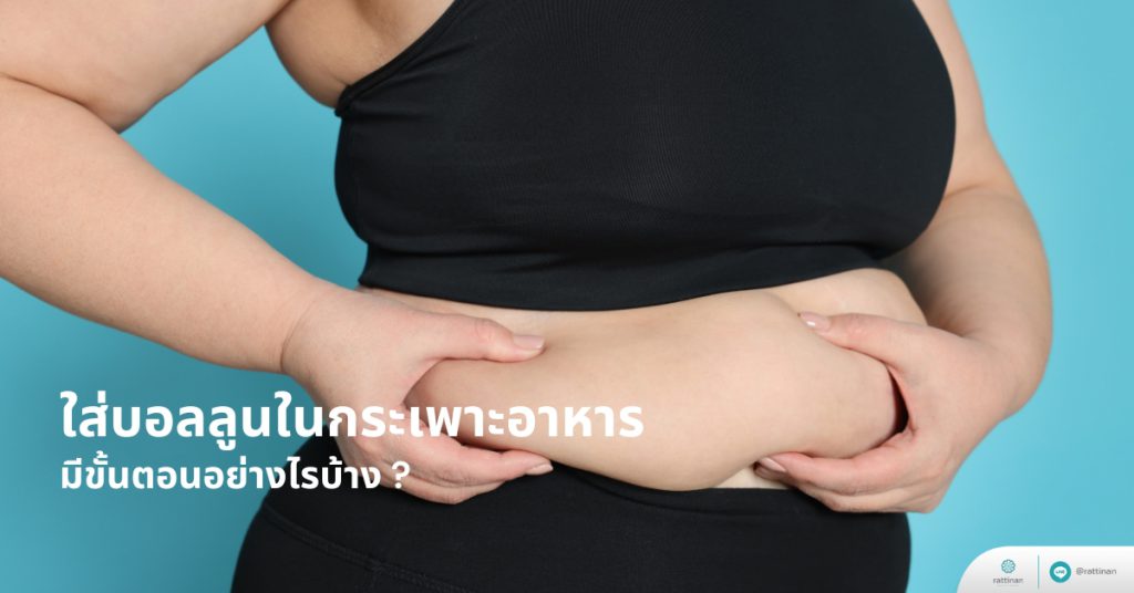 ใส่บอลลูนกระเพาะอาหาร มีขั้นตอนอย่างไร
