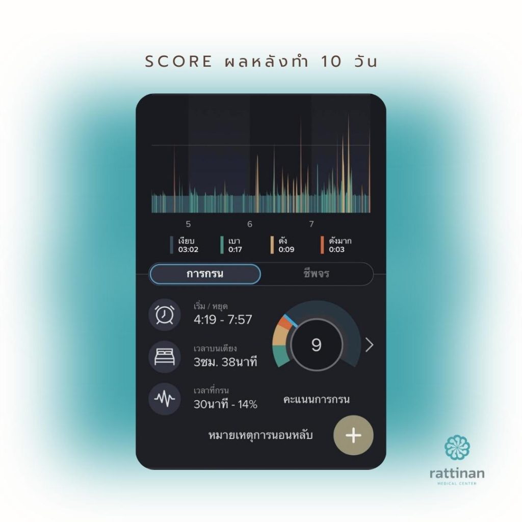 รีวิวเลเซอร์รักษานอนกรน Score ผลหลังทำเลเซอร์นอนกรน 10 วัน