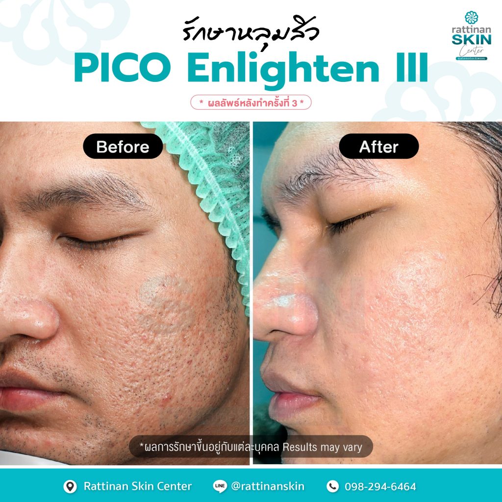 pico laser รีวิวรักษาหลุมสิว