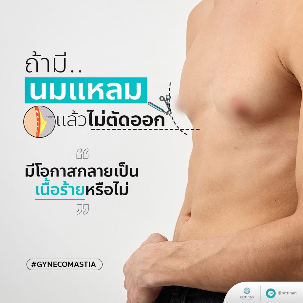 รักษานมแหลมผู้ชาย รัตตินันท์ เมดิคอล เซ็นเตอร์