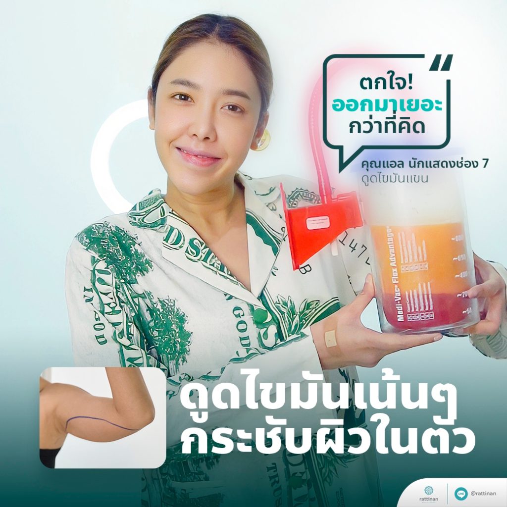 คุณแอล ดาราช่อง 7 - รีวิวดูดไขมันแขน ด้วย BodyTite Pro และ PAL