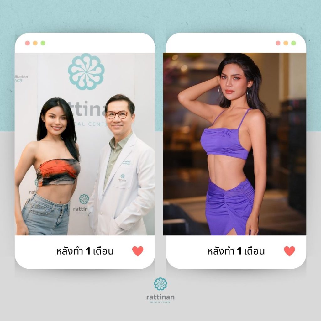 รีวิว ดูดไขมันต้นแขน หลังทำ 1 เดือน ดูดไขมันแขน