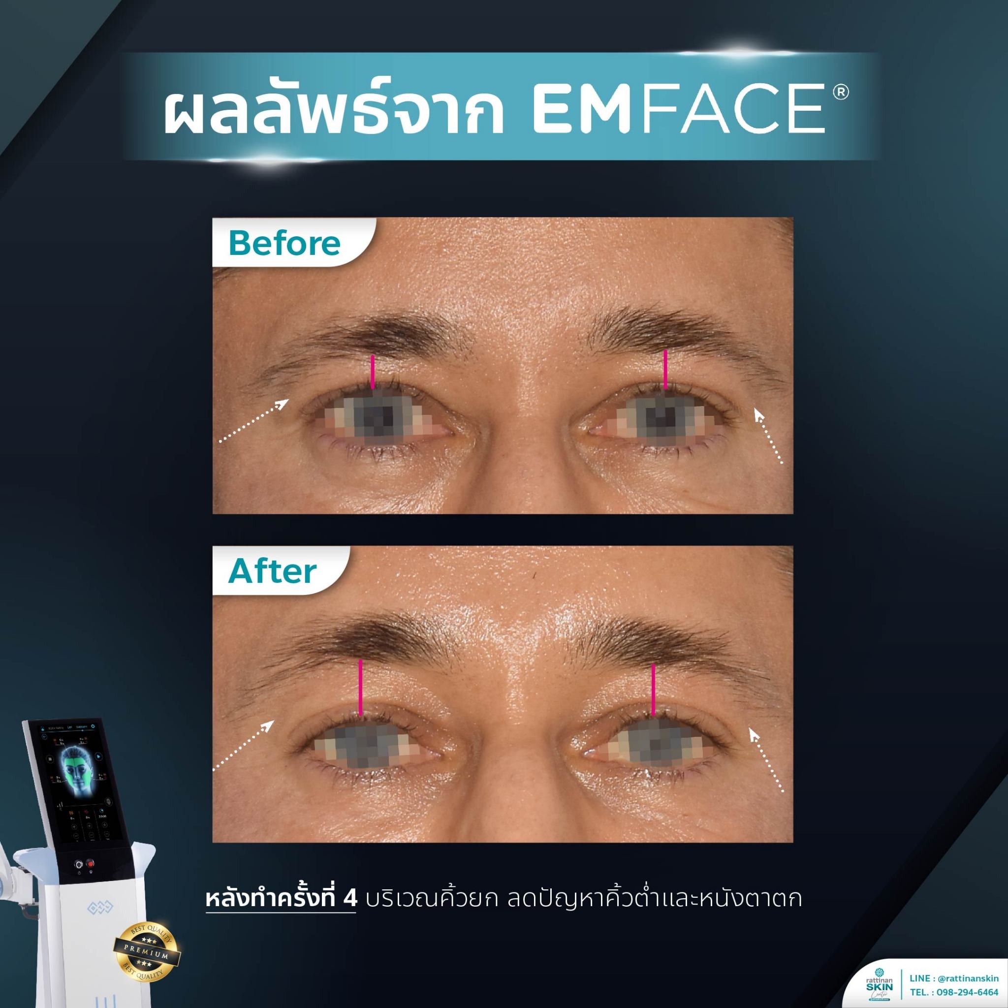 รีวิว Emface ตาชัดขึ้น