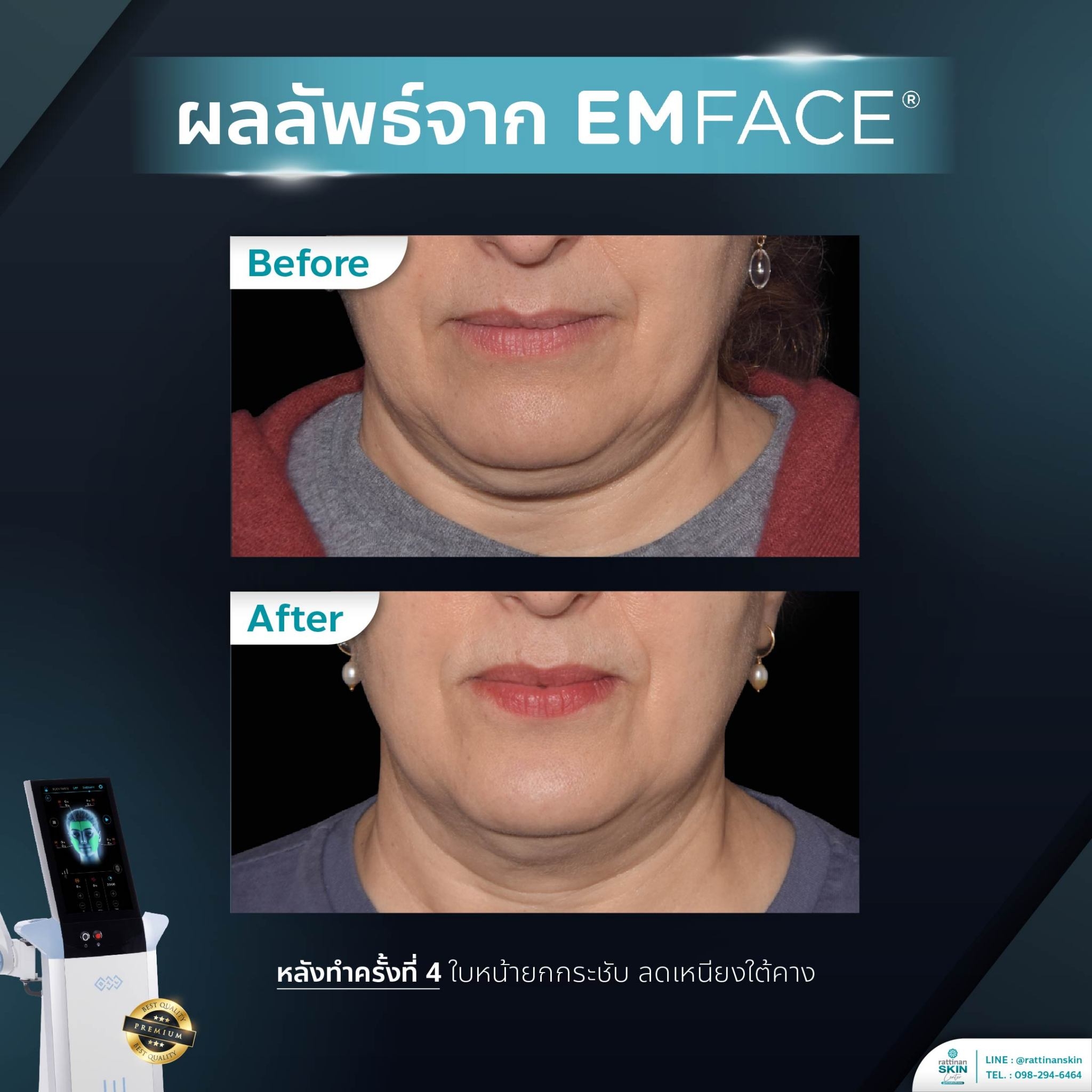 รีวิว Emface เหนียงยก