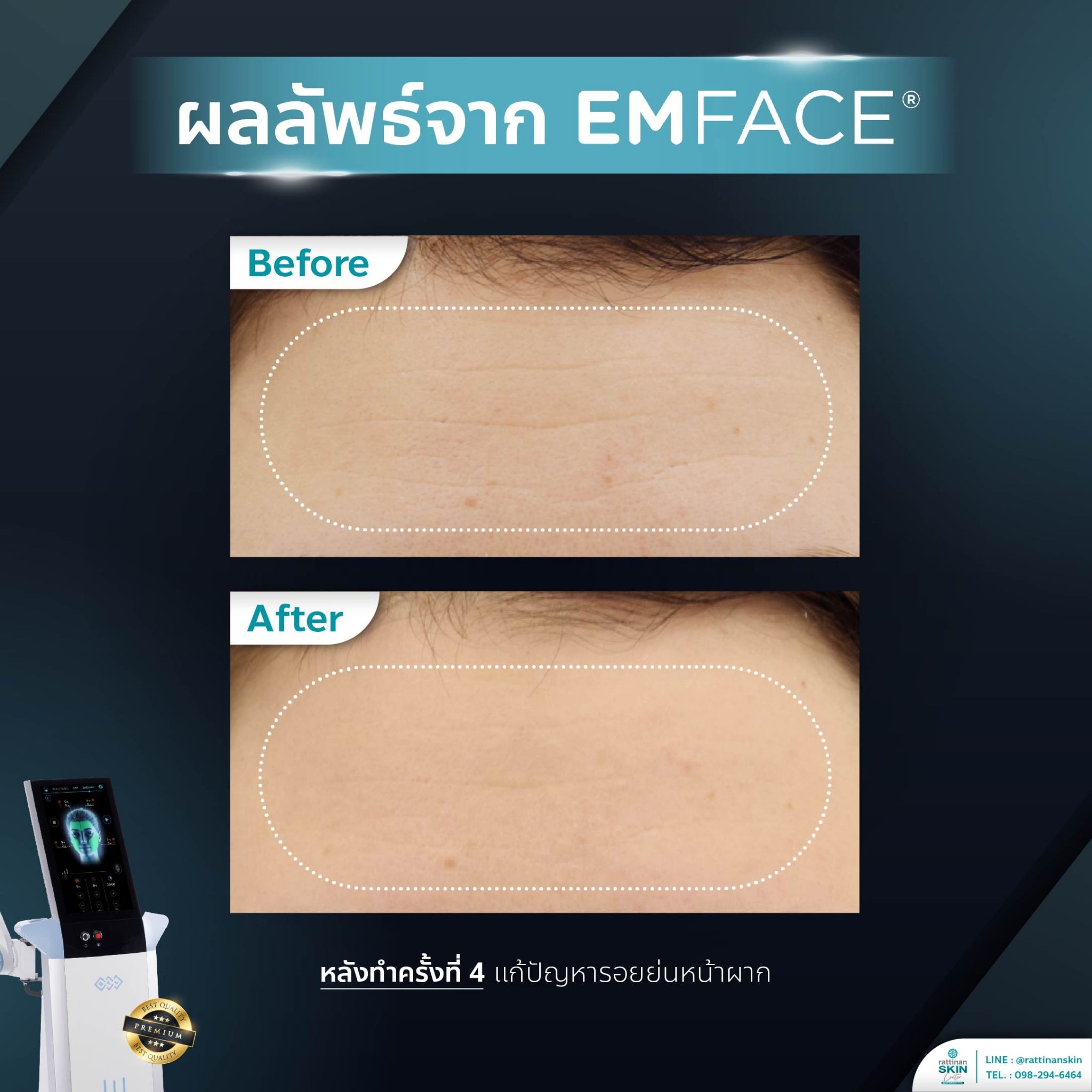 รีวิว Emface ริ้วรอยลด