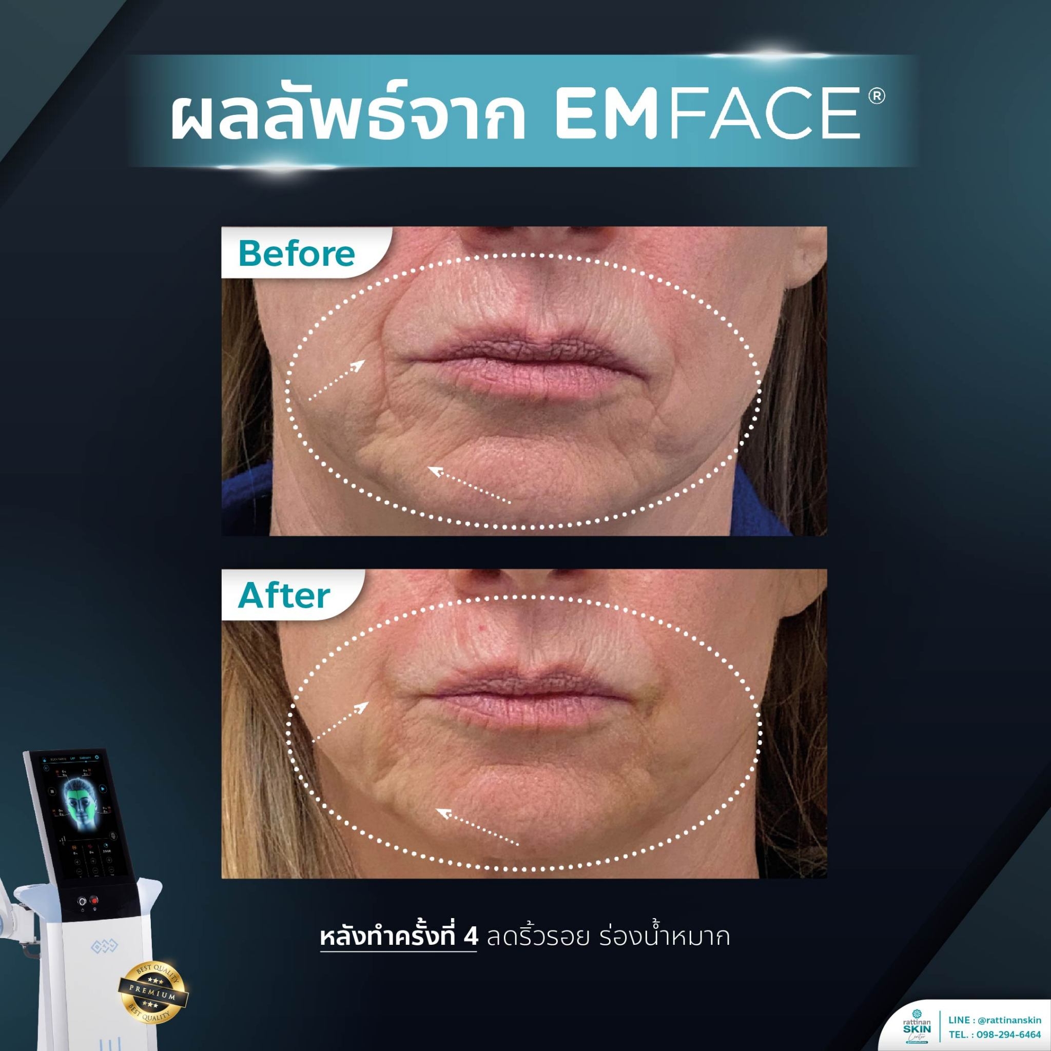 รีวิว Emface ผิวเรียบเนียน