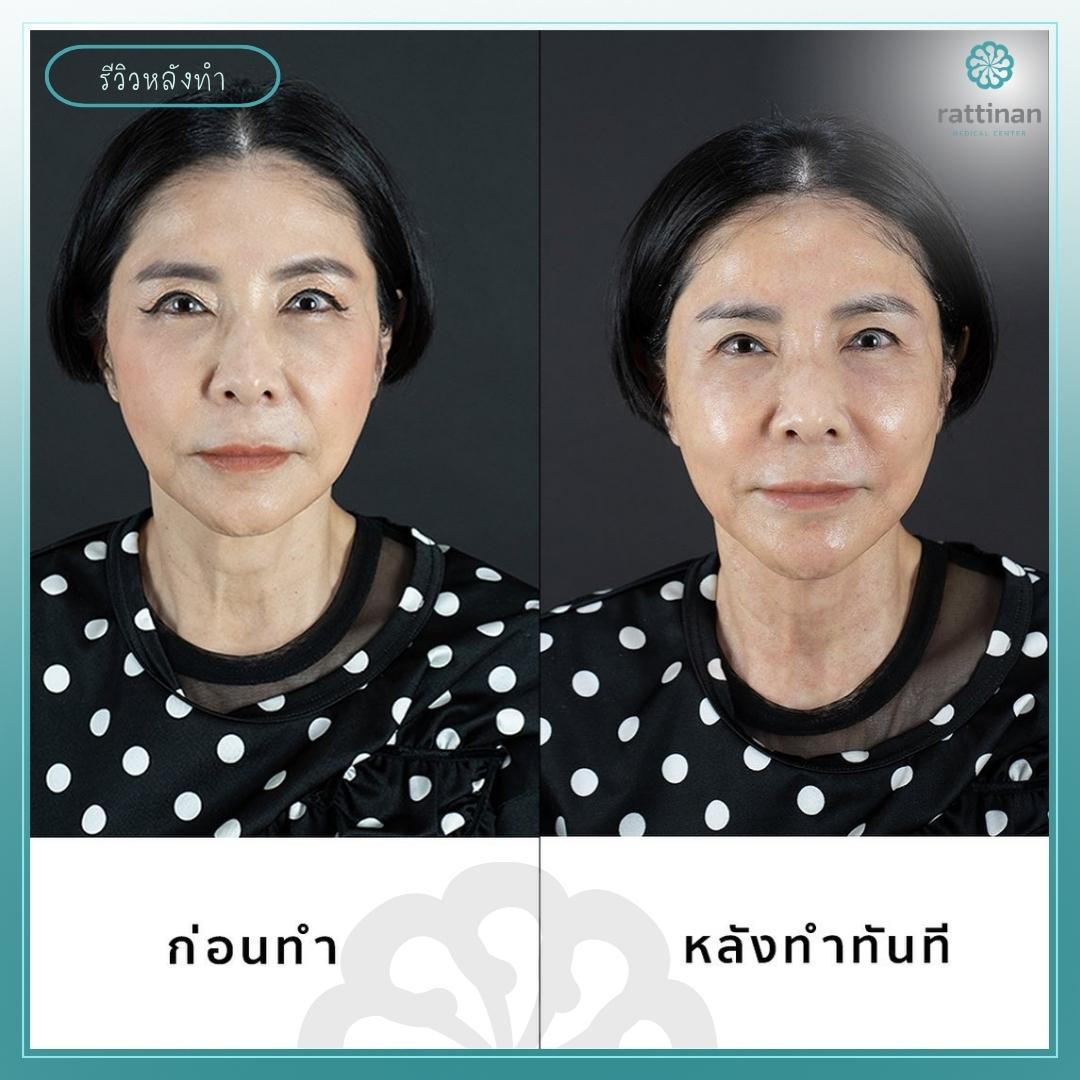 รีวิวหลังทำ Morpheus ทันที