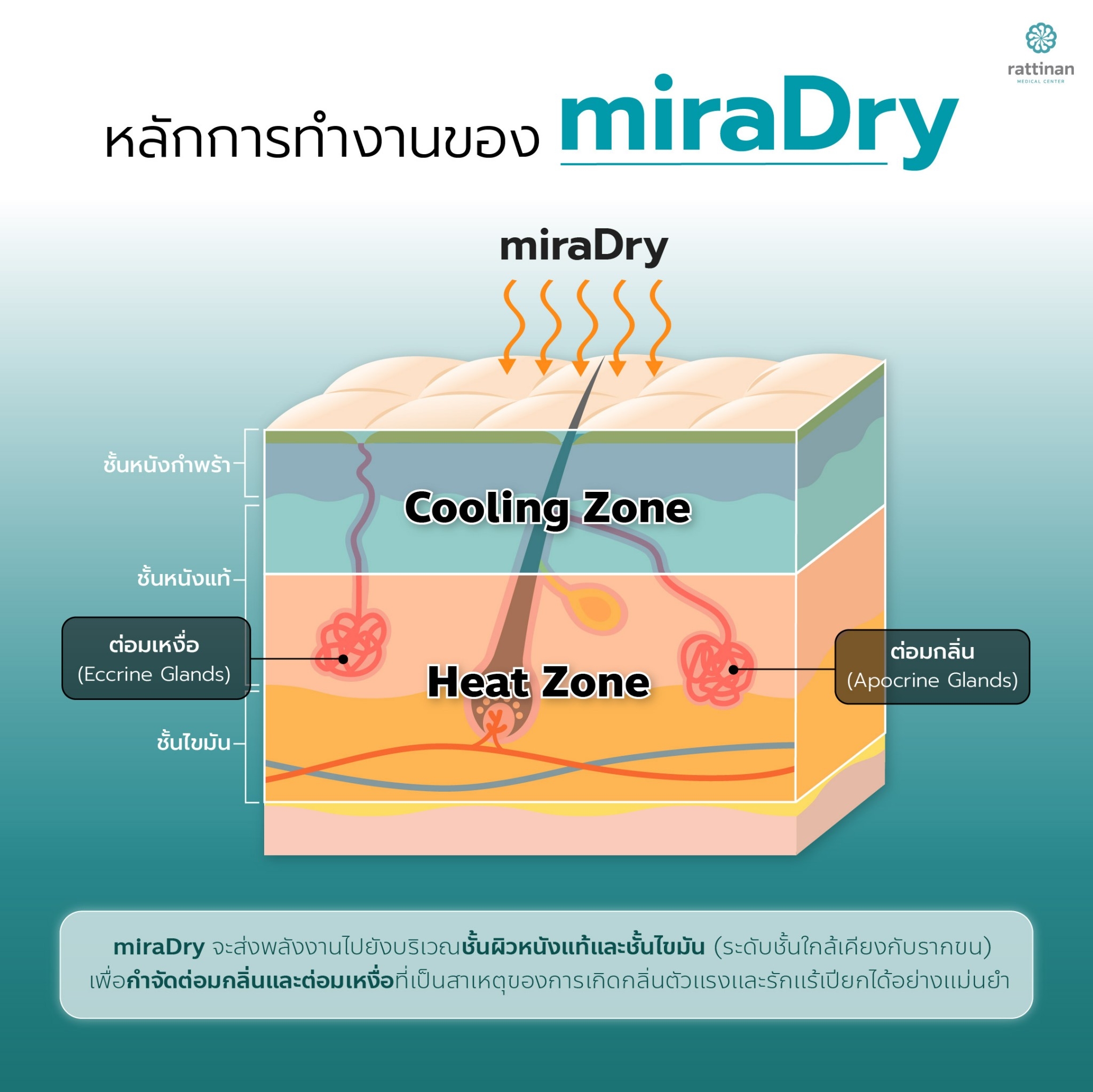 หลักการทำงานของ miraDry