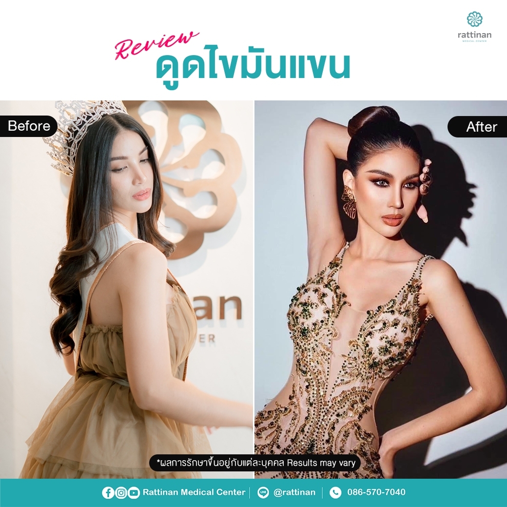 รีวิวดูดไขมัน sexy line สร้างกล้ามหน้าท้อง ร่อง 11 (1)