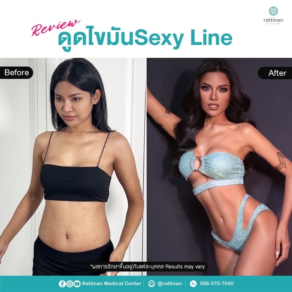 รีวิวดูดไขมัน sexy line - มิน วรวลัญช์ พุฒกลาง Miss Universe Thailand 2023