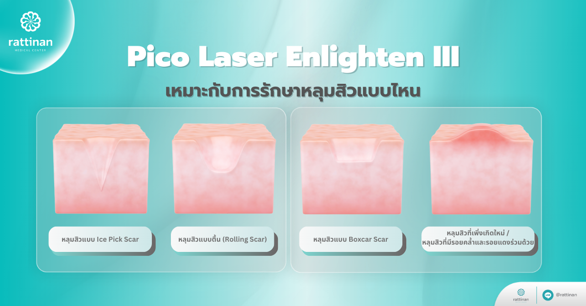 Pico Laser Enlighten III เหมาะกับการรักษาหลุมสิวแบบไหน