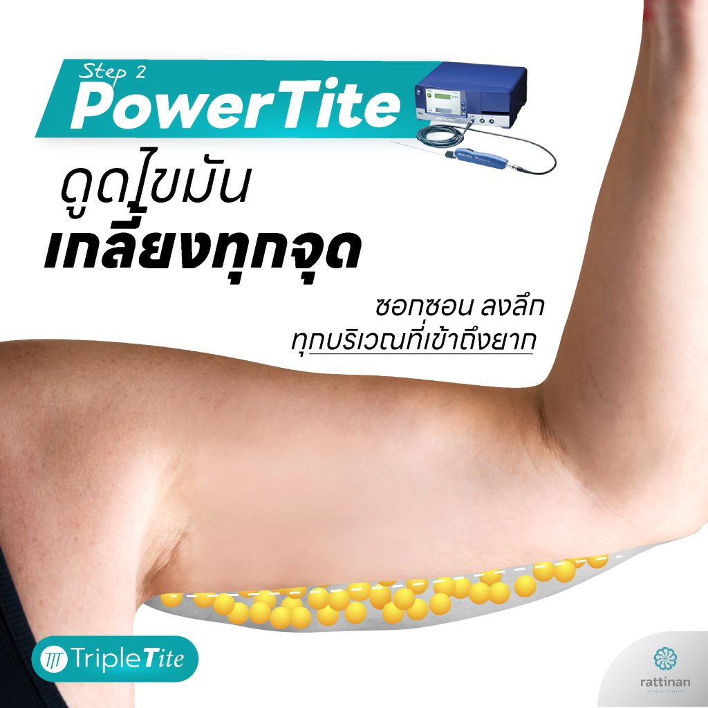 ดูดไขมัน PowerTite