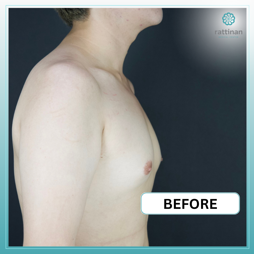 ศัลยกรรม Gynecomastia BEFORE