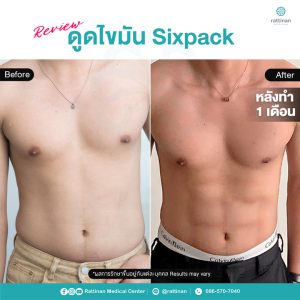 รีวิวดูดไขมันหน้าท้อง ซิกแพค ไม่มีแผลหน้าท้อง