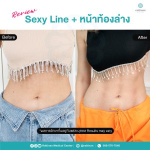 รีวิว ดูดไขมันหน้าท้อง ดูดไขมัน sexy line