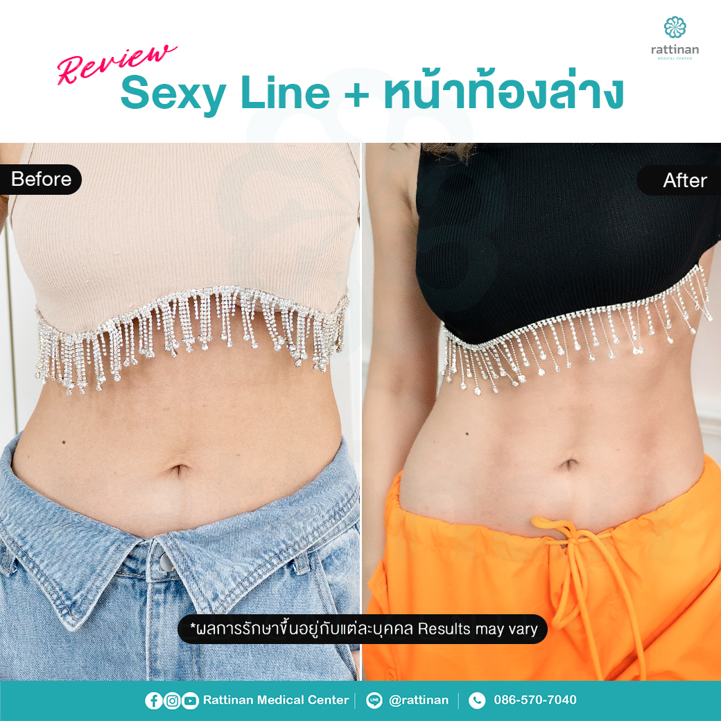 รีวิว ดูดไขมันหน้าท้อง ดูดไขมัน sexy line