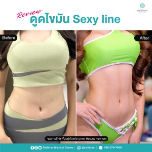 ดูดไขมัน sexy line ไร้แผลหน้าท้อง