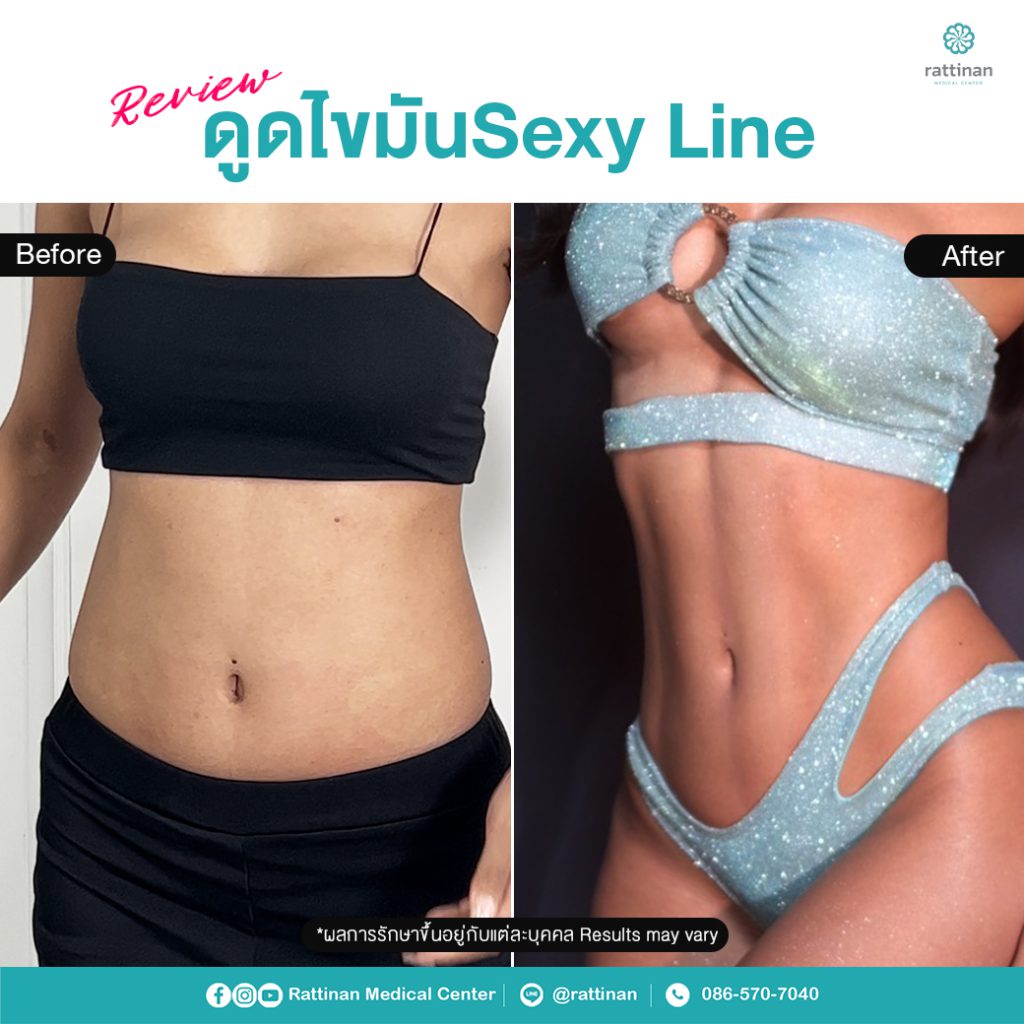 review Sexy line liposuction - BodyTite Pro + PAL