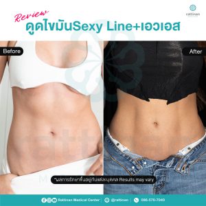 รีวิว ดูดไขมันเอวเอส ดูดไขมัน sexy line