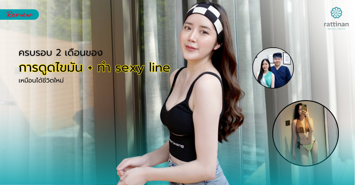 ครบรอบ 2 เดือนของการดูดไขมัน + ทำ sexy line