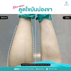 ดูดไขมันน่องขา ลดน่องปูด ด้วย BodyTite Pro และ PAL