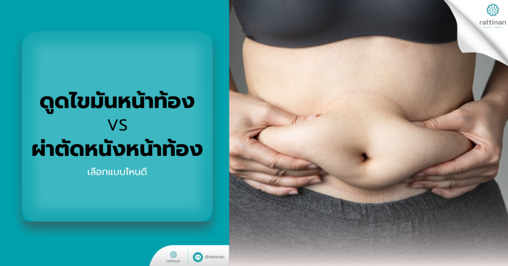 ดูดไขมันหน้าท้อง VS ผ่าตัดหนังหน้าท้อง